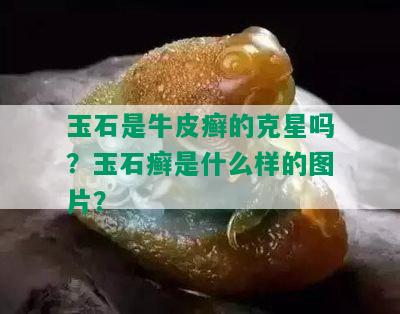 玉石是牛皮癣的克星吗？玉石癣是什么样的图片？